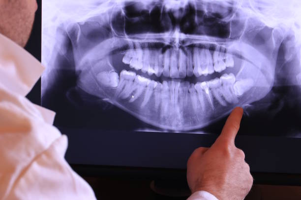Best Emergency Wisdom Teeth Removal in Whiskey Creek, FL